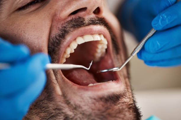 Best Root Canal Emergency Dentist  in Mobridge, SD